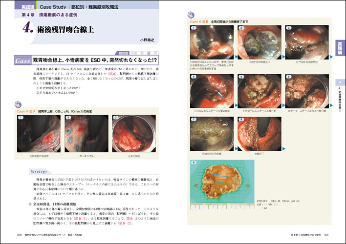 3冊セット 食道・胃ＥＳＤ　改訂版 -（症例で身につける消化器内視鏡（ＤＶＤ付） 症例で身につける消化器内視鏡シリーズ：食道・胃ESD 改訂版〜IT