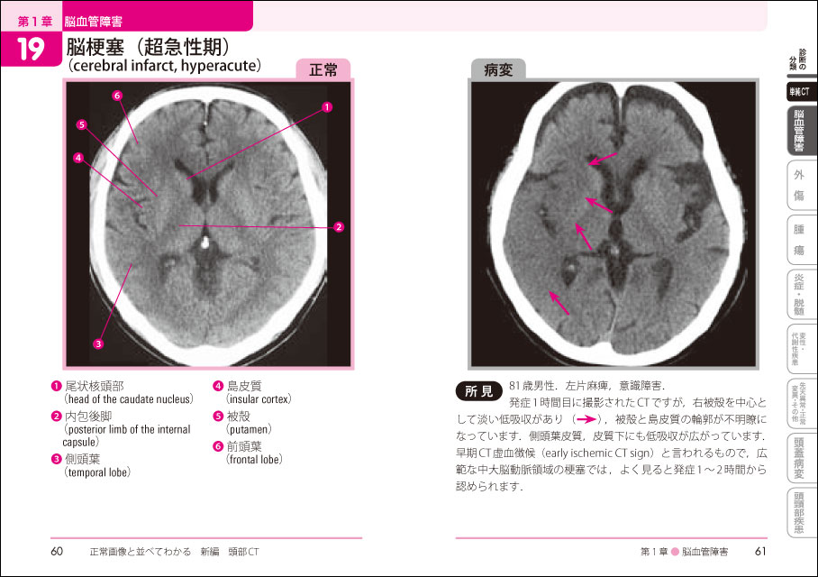 頭 打っ た ct 異常 なし