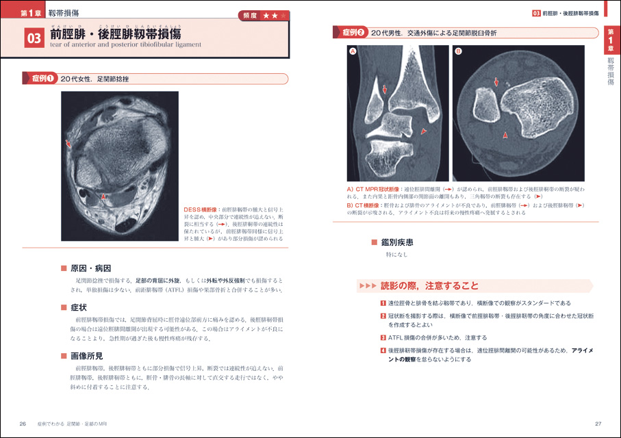 症例でわかる足関節・足部のMRI?すぐに役立つ撮り方・読み方のポイント