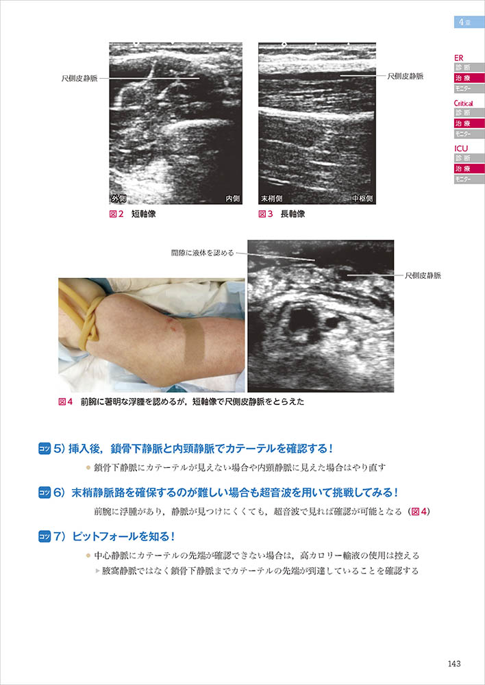 精巣 捻転 エコー