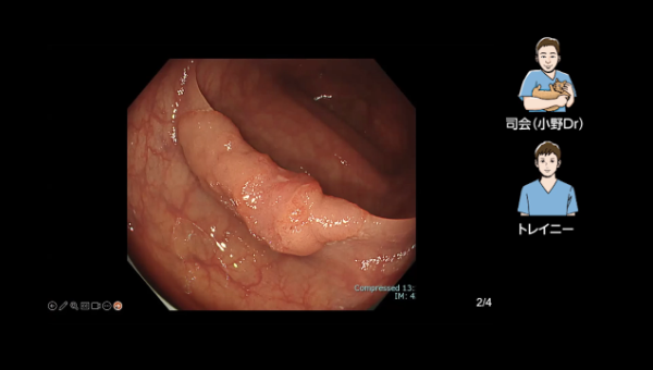 Case 001 大腸 上行結腸 隆起性病変 サムネール