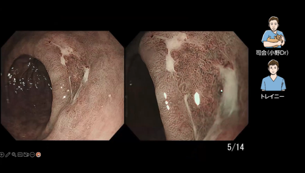Case 002 胃 前庭部後壁 陥凹性病変 サムネール