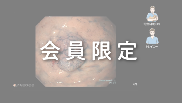 Case 005 胃 穹窿部 隆起性病変 サムネール