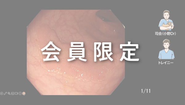 Case 015 大腸 S状結腸 平坦隆起性病変 サムネール