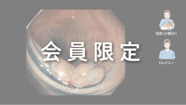 Case 018 大腸 S状結腸 隆起性病変 サムネール