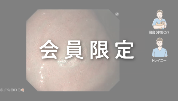 Case 022 胃 体中部大弯 平坦隆起性病変 サムネール