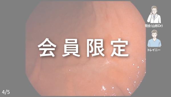 Case 027 胃 体下部 陥凹性病変 サムネール