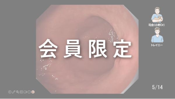 Case 041 胃 体部小弯 陥凹性病変 サムネール