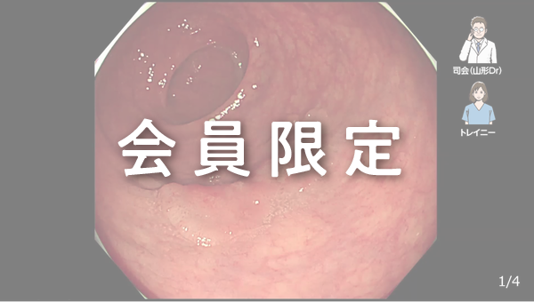 Case 043 大腸 直腸 陥凹性病変 サムネール
