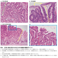 図4　正常と癌を見きわめるための組織の観察ポイント