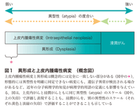 図1　異形成と上皮内腫瘍性病変　（概念図）