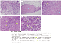 図2　肉芽組織と肉芽腫
