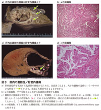 図3　肝内の嚢胞性／胆管内腫瘍