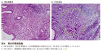 図4　胃の印環細胞癌