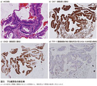 図5　75歳男性の肺生検