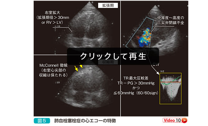 肺血栓塞栓症の心エコーの特徴