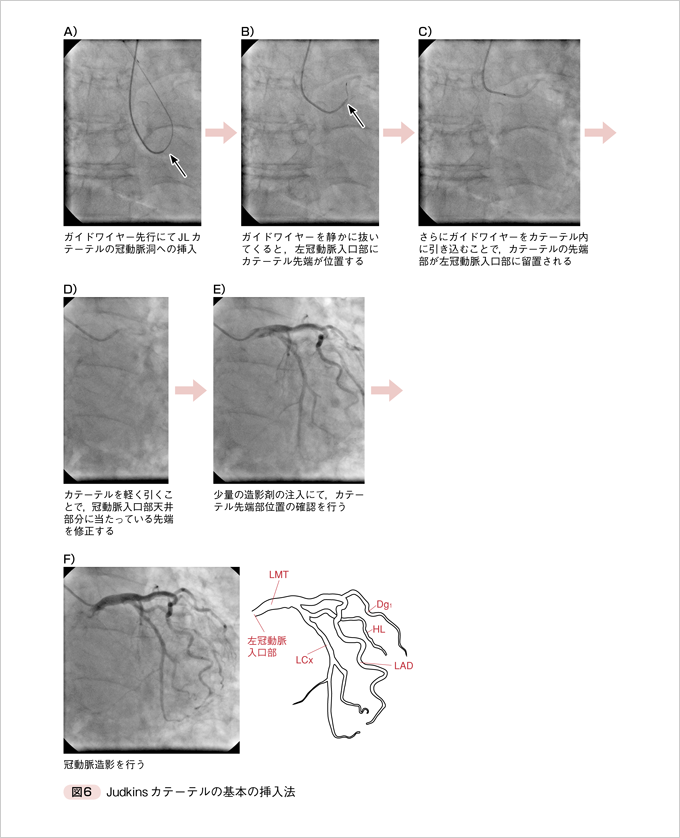 改訂版 確実に身につく心臓カテーテル検査の基本とコツ　立ち読み4