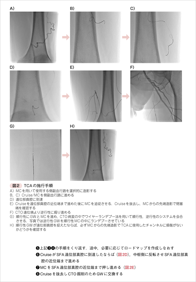 改訂版 格段にうまくいく EVTの基本とコツ　立ち読み3