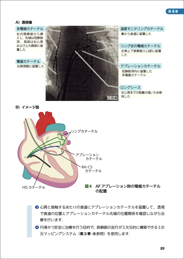 やさしくわかるカテーテルアブレーション　立ち読み8