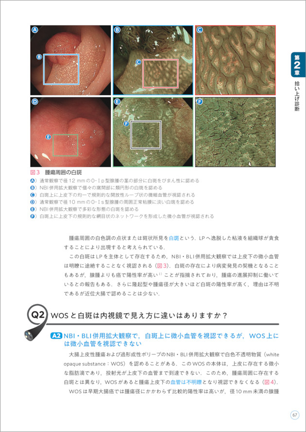 大腸内視鏡診断の基本とコツ