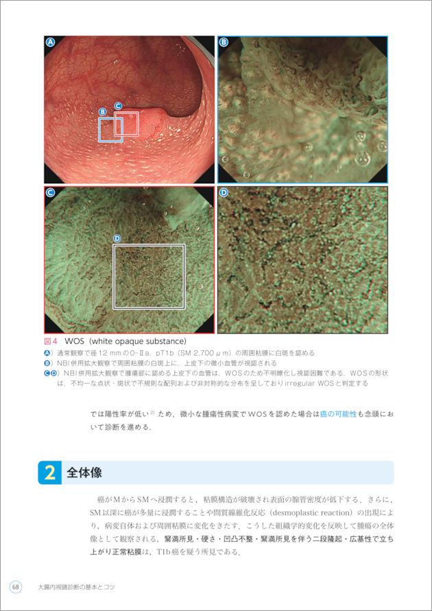 大腸内視鏡診断の基本とコツ