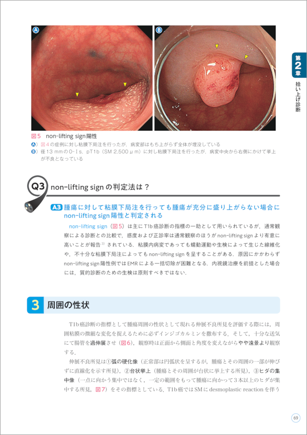 大腸内視鏡診断の基本とコツ