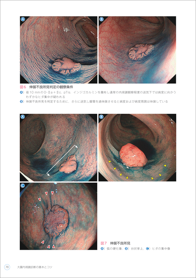 大腸内視鏡診断の基本とコツ