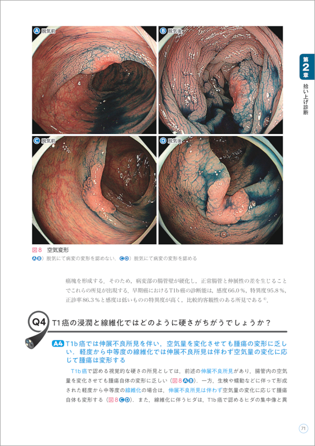 大腸内視鏡診断の基本とコツ