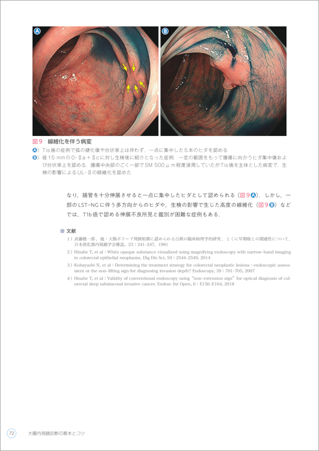 大腸内視鏡診断の基本とコツ