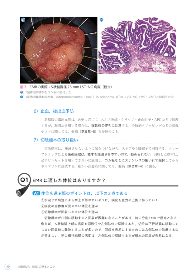 大腸EMR・ESDの基本とコツ