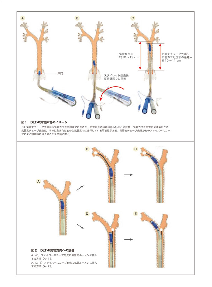 肺外科手術の麻酔　立ち読み2