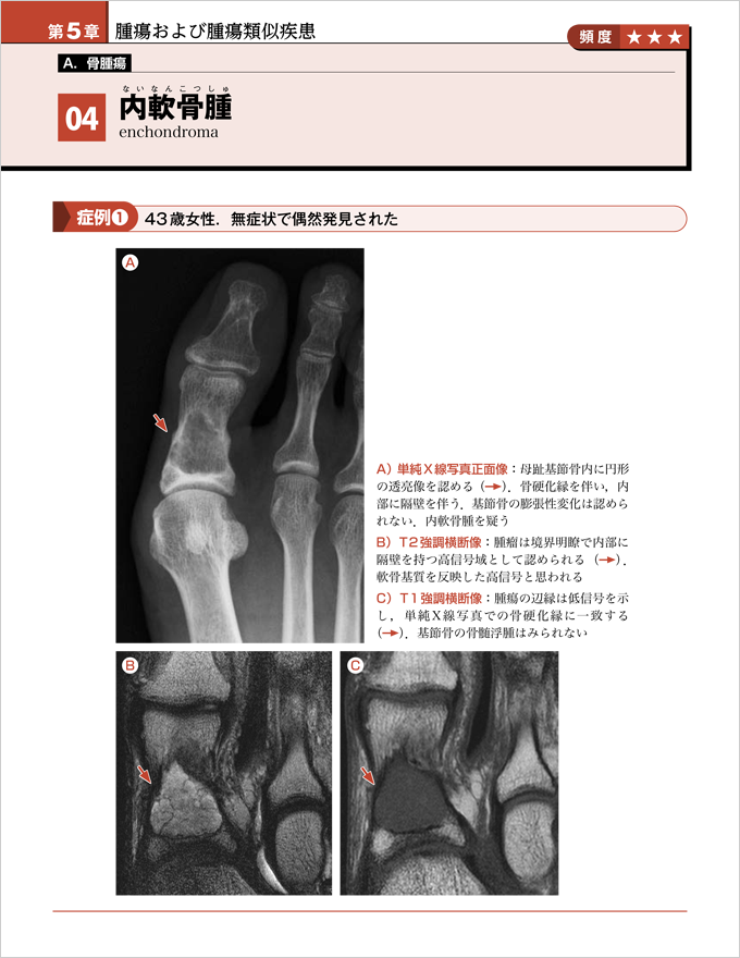 症例でわかる足関節・足部のMRI　立ち読み1