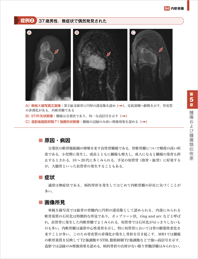 症例でわかる足関節・足部のMRI　立ち読み2