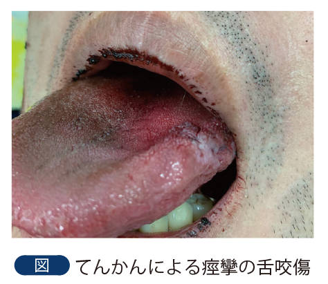 図 てんかんによる痙攣の舌咬傷