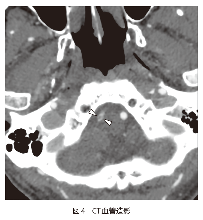 図4 CT血管造影