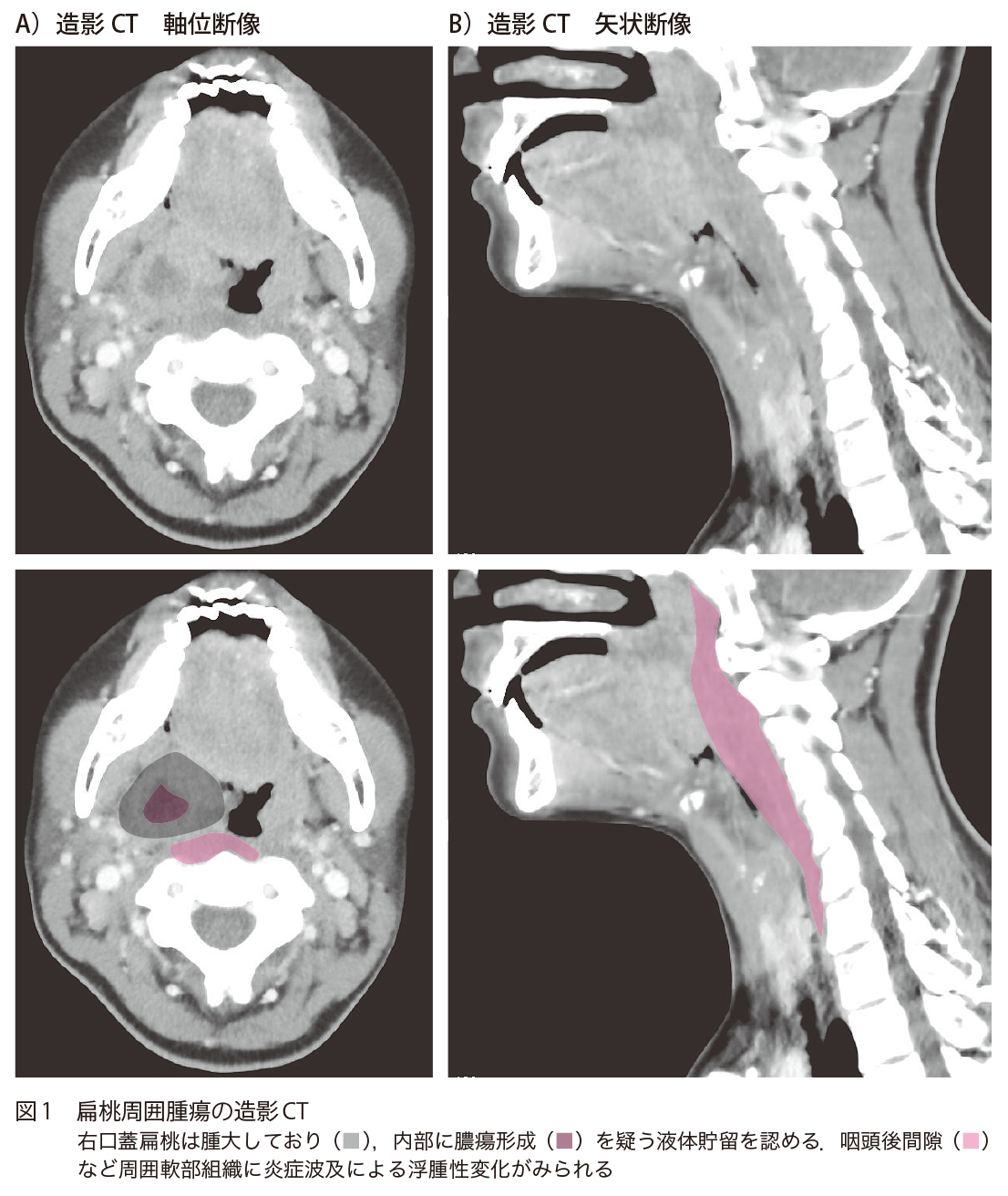 図1 扁桃周囲腫瘍の造影CT