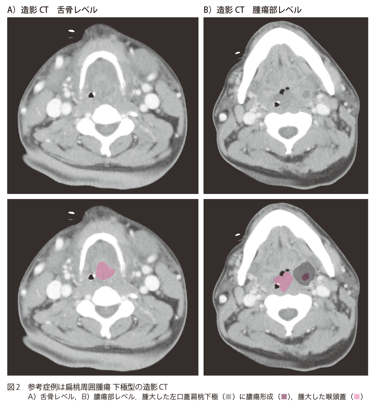 図2 参考症例は扁桃周囲腫瘍 下極型の造影CT