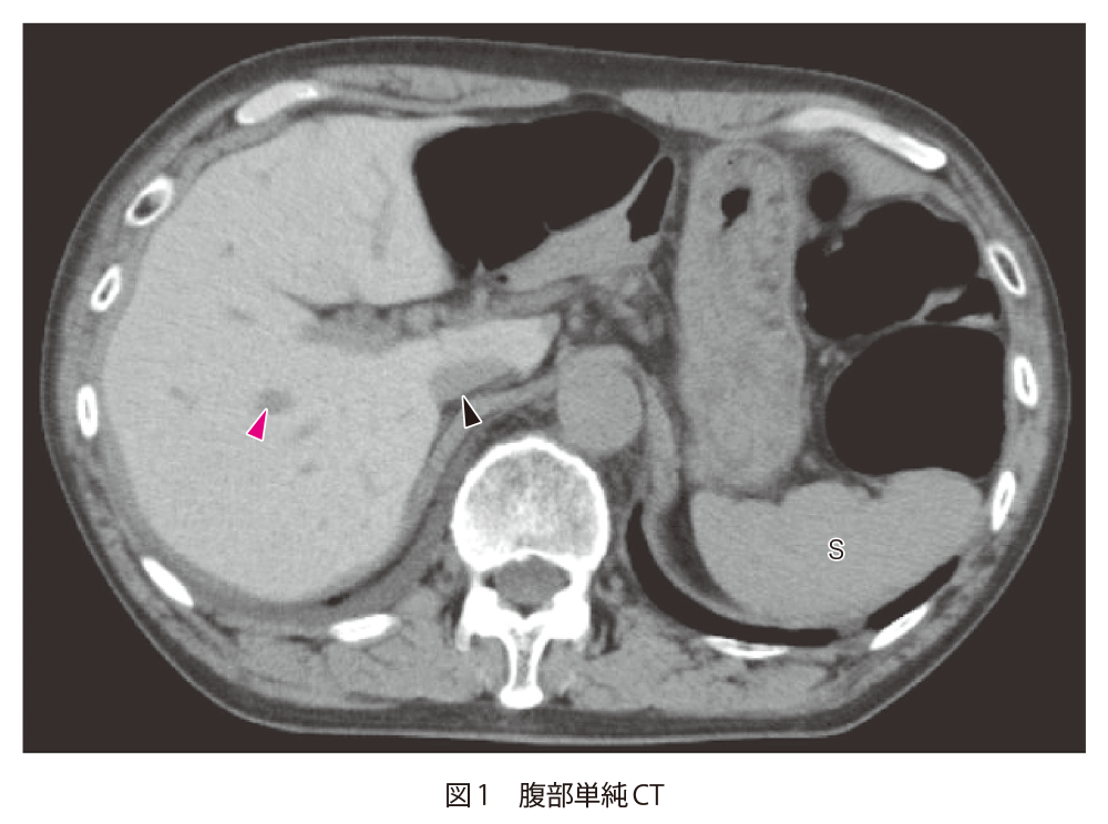 図1 腹部単純CT