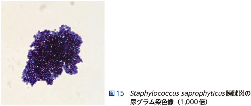 図15　 Staphylococcus saprophyticus 膀胱炎の尿グラム染色像（1,000 倍）