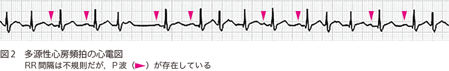 図2　多源性心房頻拍の心電図