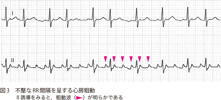 図3　不整なRR間隔を呈する心房粗動