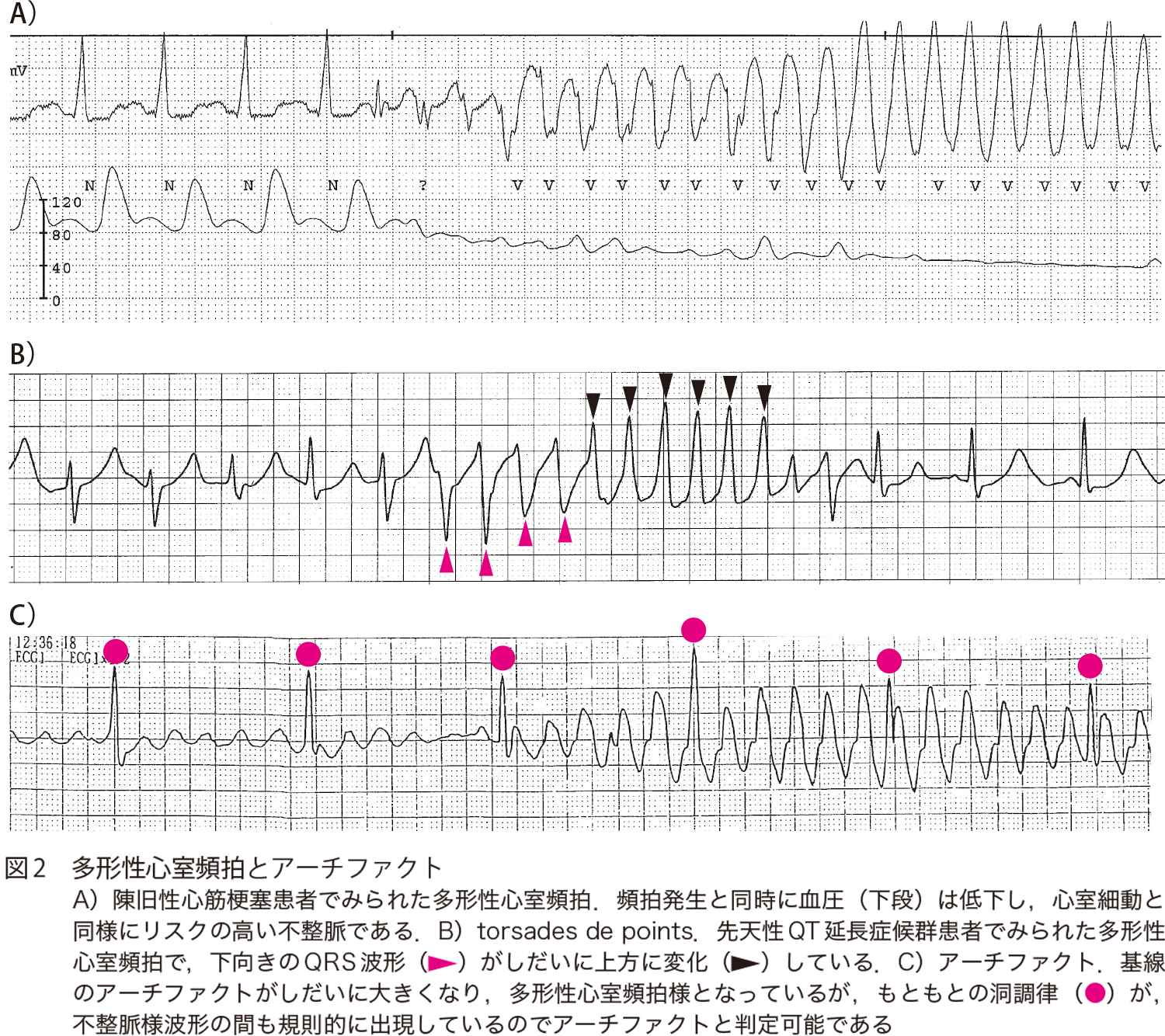 図2　多形性心室頻拍とアーチファクト