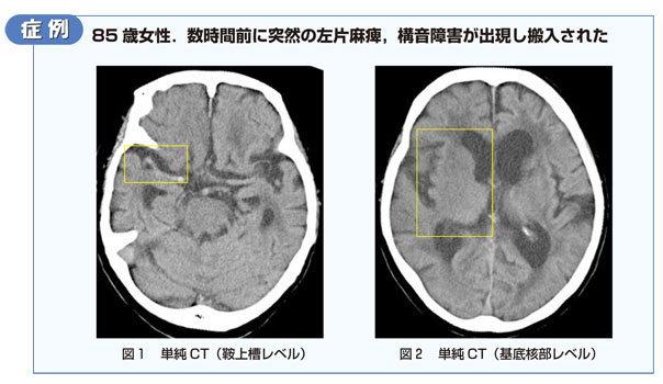 第1回 超急性期脳梗塞を見逃すな 知っておきたいearly Ct Sign 画像診断ワンポイントレッスン 羊土社 レジデントノート 羊土社