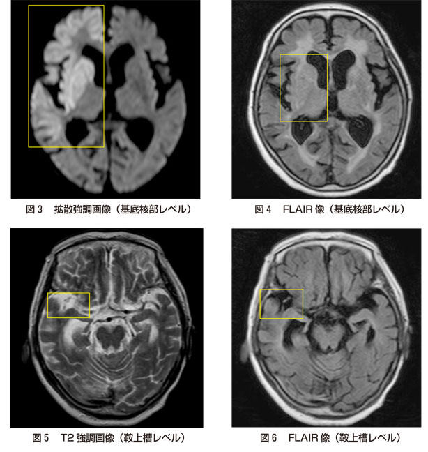 第1回 超急性期脳梗塞を見逃すな 知っておきたいearly Ct Sign 画像診断ワンポイントレッスン 羊土社 レジデントノート 羊土社