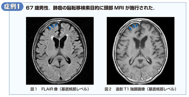 症例1　67歳男性．肺癌の脳転移検索目的に頭部MRIが施行された．