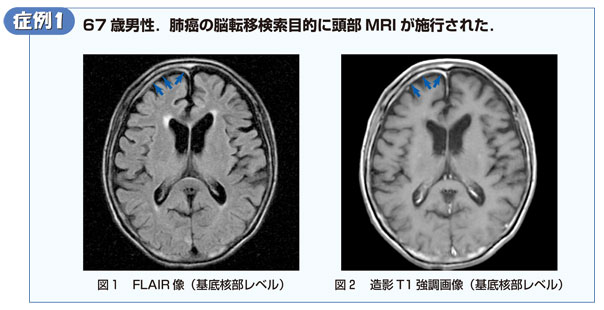 第2回 髄膜がわかると病気がみえてくる 症例から学ぶ髄膜とその周辺構造 羊土社