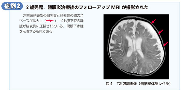 症例2　2歳男児．髄膜炎治療後のフォローアップMRIが撮影された