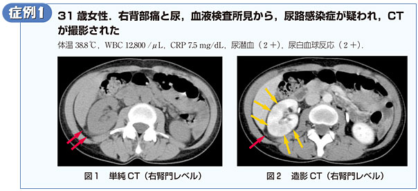 症例1　31歳女性．右背部痛と尿，血液検査所見から，尿路感染症が疑われ，CTが撮影された