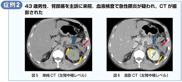 症例2　43歳男性．背部痛を主訴に来院．血液検査で急性膵炎が疑われ，CTが撮影された