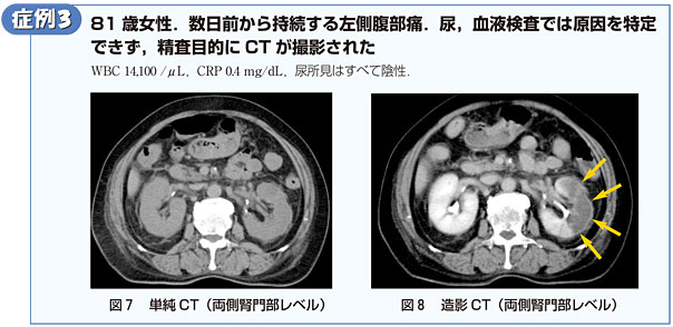 症例3　81歳女性．数日前から持続する左側腹部痛．尿，血液検査では原因を特定できず，精査目的にCTが撮影された